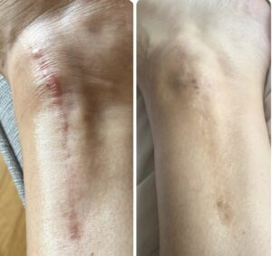 Scar revision chesterfield