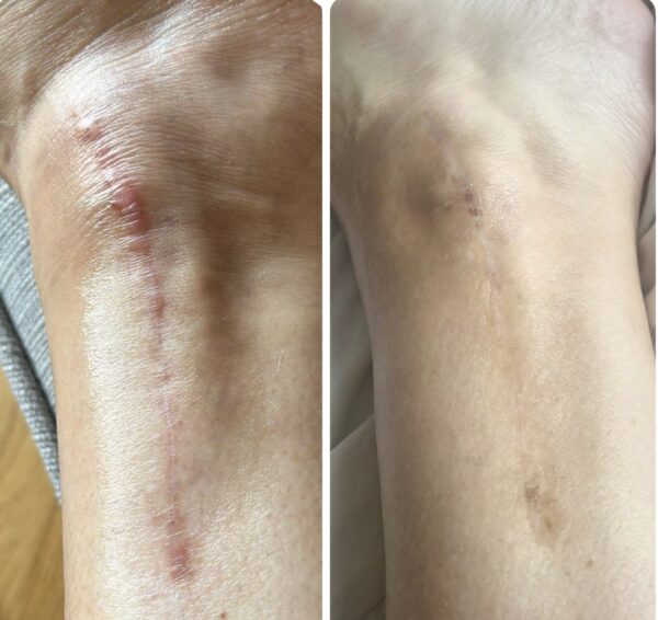 Scar revision chesterfield